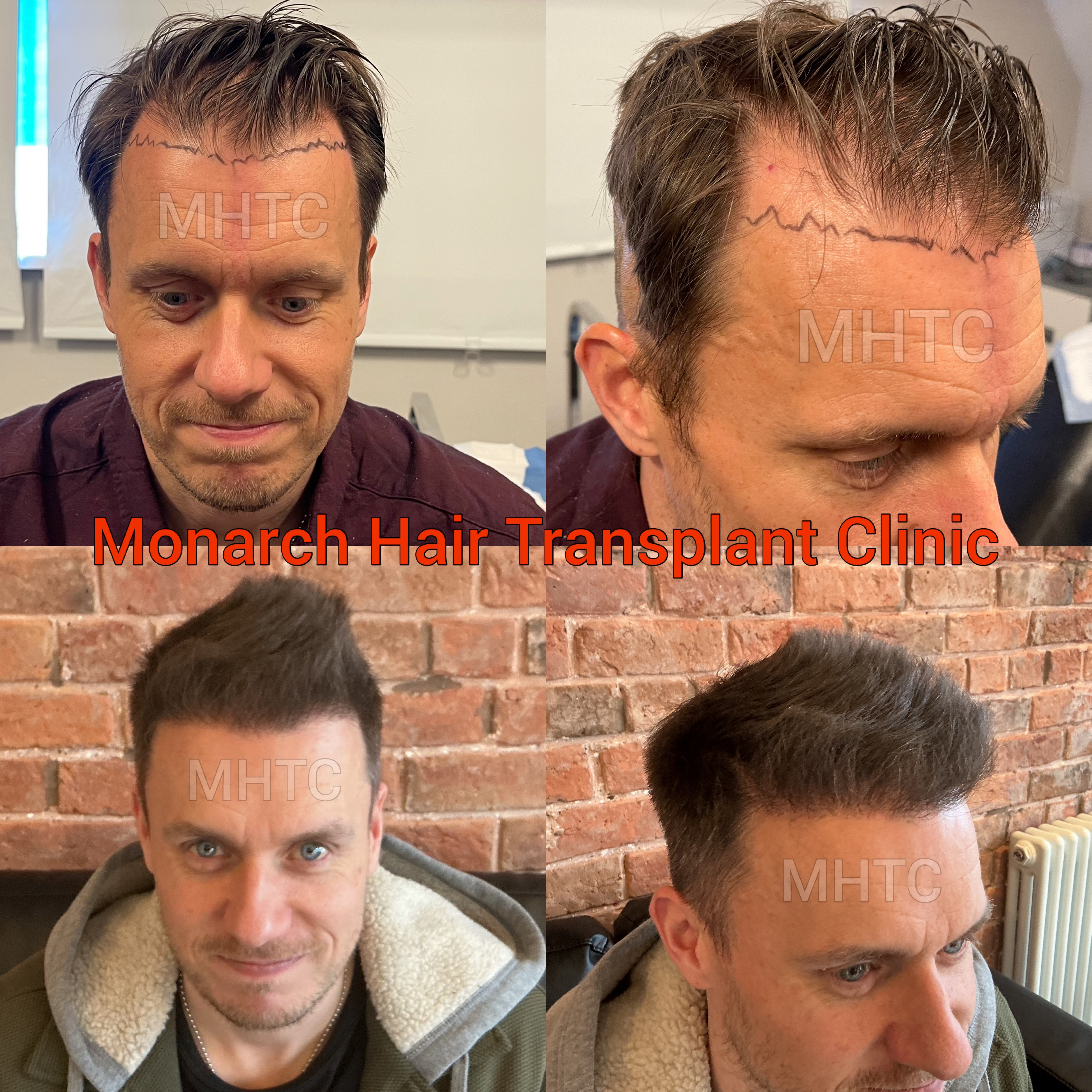 Natural hairline blending into existing hair
